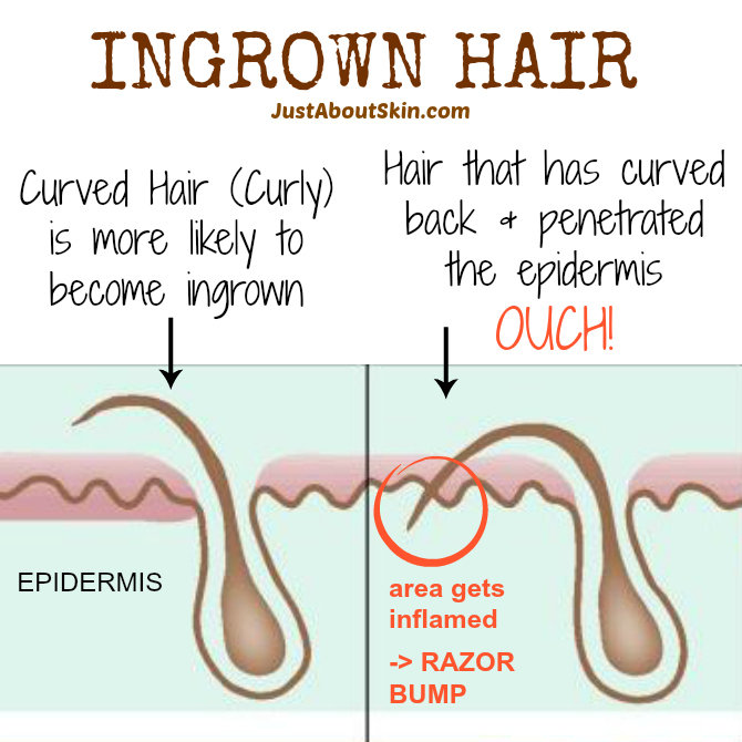 Tips For Preventing Ingrown Hairs Just About Skin