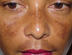 Melasma Treatment Before & After Pictures - RealSelf