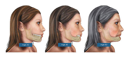 facial bone loss progression (jaw)