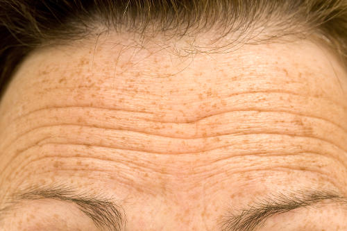 forehead lines pigmentation woman