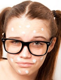young girl spotted with zit cream